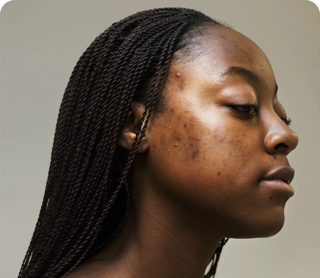 pimples collection image